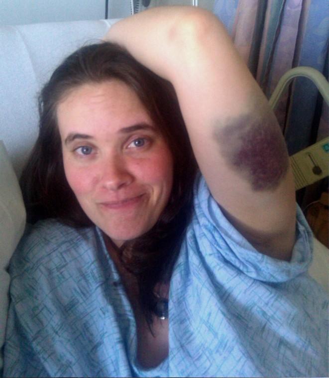 bruise1:Senior jazz studies major Kate Janzen shows her bruise while at the hospital, being treated for idiopathic thrombocytopenic purpura.:Courtesy Photo